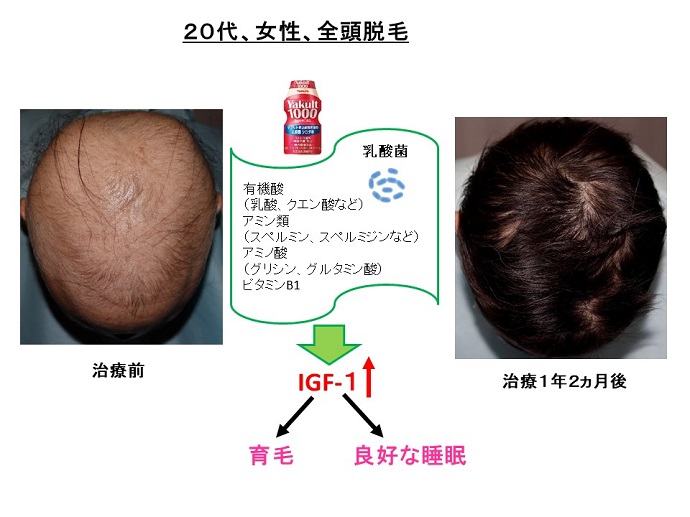 円形脱毛症　病院